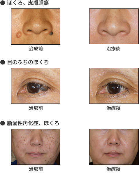 ほくろ 皮膚腫瘍など 美肌 神戸市北区藤原台の形成外科 みずぐち形成外科クリニック