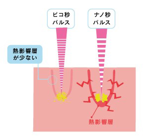 痛みが少ない照射