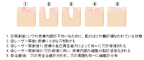 フラクショナル(=まばら)照射と肌再生のしくみ