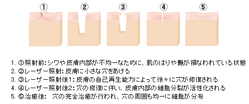 フラクショナル(＝まばら)照射と肌再生のしくみ