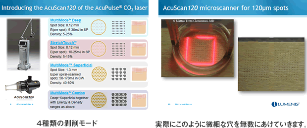 4種類の剥削モード　実際にこのように微細な穴を無数にあけていきます