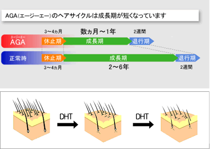 AGAの原因